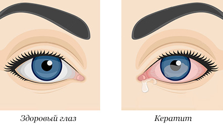 Сравнение здорового глаза и пораженного кератитом