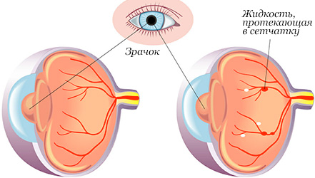 Сравнение здорового глаза и с диабетической ретинопатией