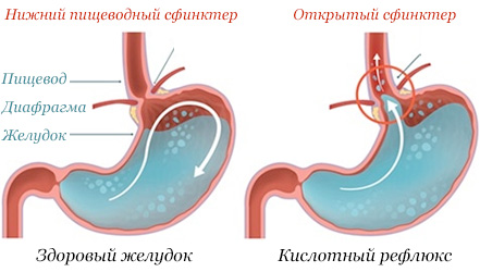 Сравнение здорового желудка и с открытым сфинктером