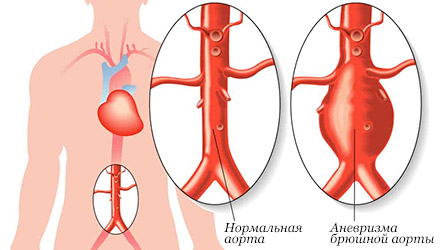 Аневризма брюшной аорты