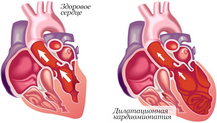 Сравнение здорового сердца и с дилатационной кардиомиопатией