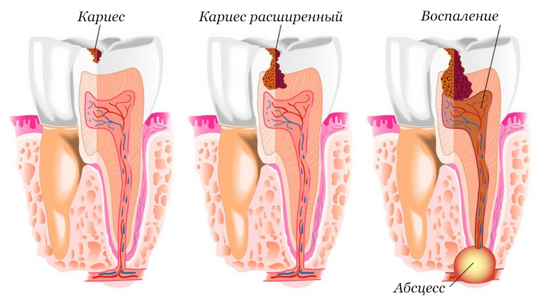 Этапы порчи зуба - кариес начальный, расширенный и с воспалением