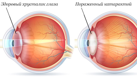Сравнение здорового хрусталика глаза и пораженного катарактой