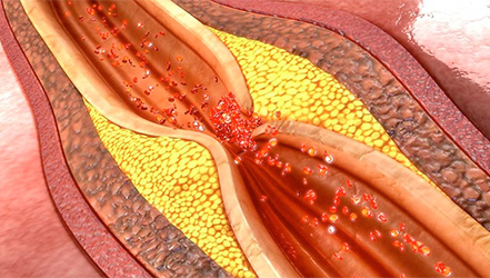 Образование атеросклеротических бляшек в артерии