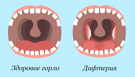 Сравнение здорового горла и пораженного дифтерией (иллюстрация)
