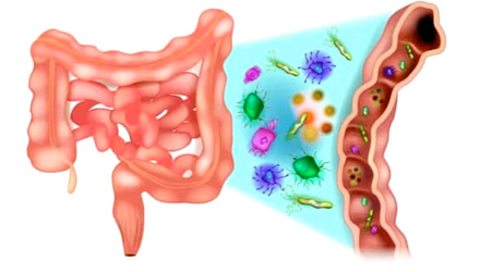 Дисбактериоз кишечника - плохая микрофлора (иллюстрация)