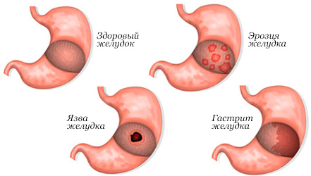 Сравнение здорового желудка с эрозией, язвой и гастритом