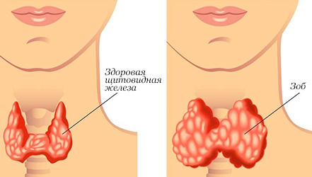 Сравнение здоровой и увеличеной щитовидки