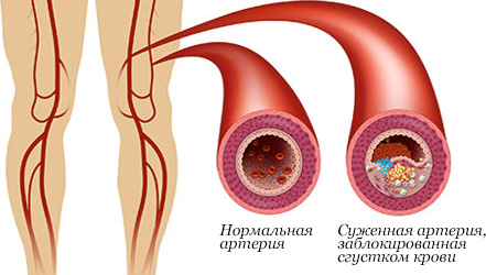 Сравнение нормальной артерии и заблокированной сгустком крови