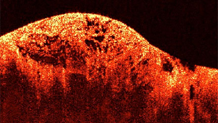 Саркома, фото сделано с помощью  ОКТ (оптической когерентной томографии)