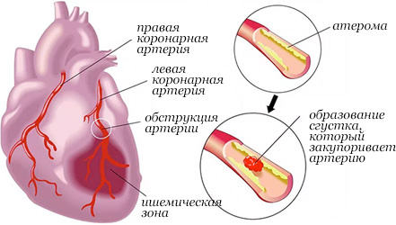 Иллюстрация инфаркта миокарда