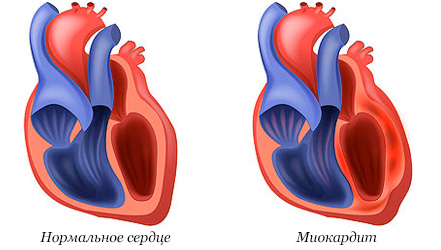 Сравнение нормального сердца и при миокардите