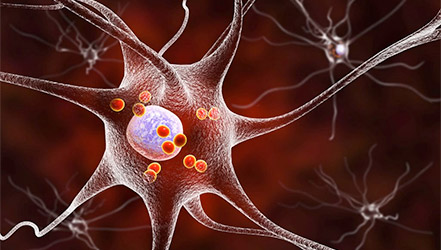 Нейроны при болезни Паркинсона