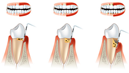 Схема поражения зубом пародонтозом