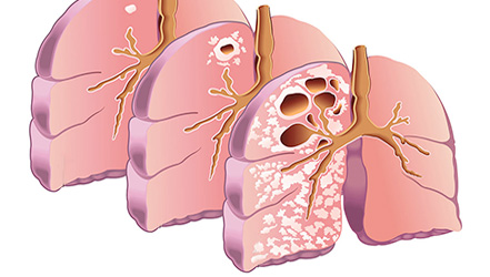 Схема распространения туберкулеза легких