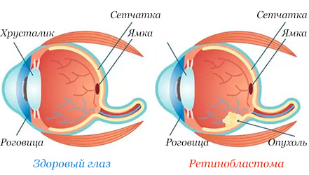 Опухоль глаза илюстрация