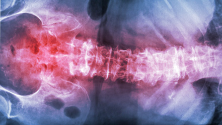 Рентгеновский снимок при сколиозе и спондилите