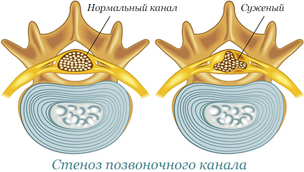 Сравнение нормального и суженого спинного канала
