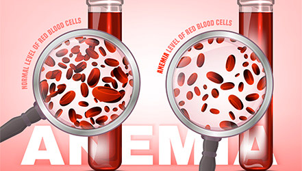 Дефицит железа в крови (анемия)